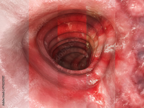 Colitis ulcerosa - all Stages- 3D rendering photo