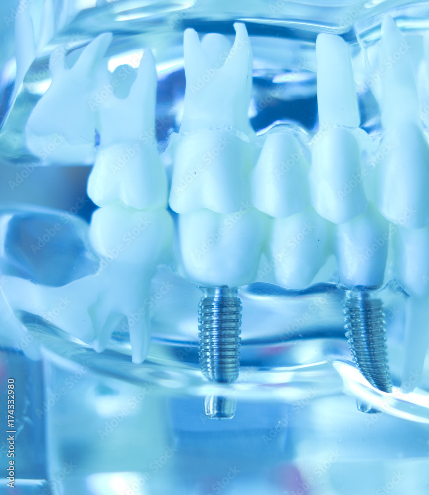 Dentsts dental tooth implant Dentsts dental tooth implant