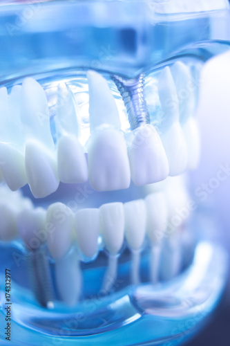 Dentsts dental tooth implant