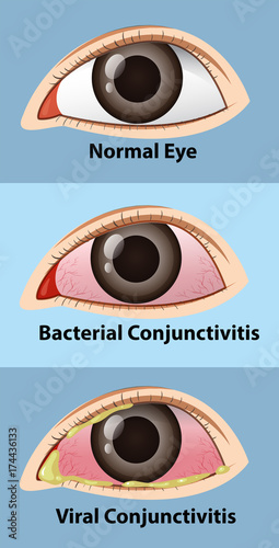Different stages of conjunctivitis in human eye