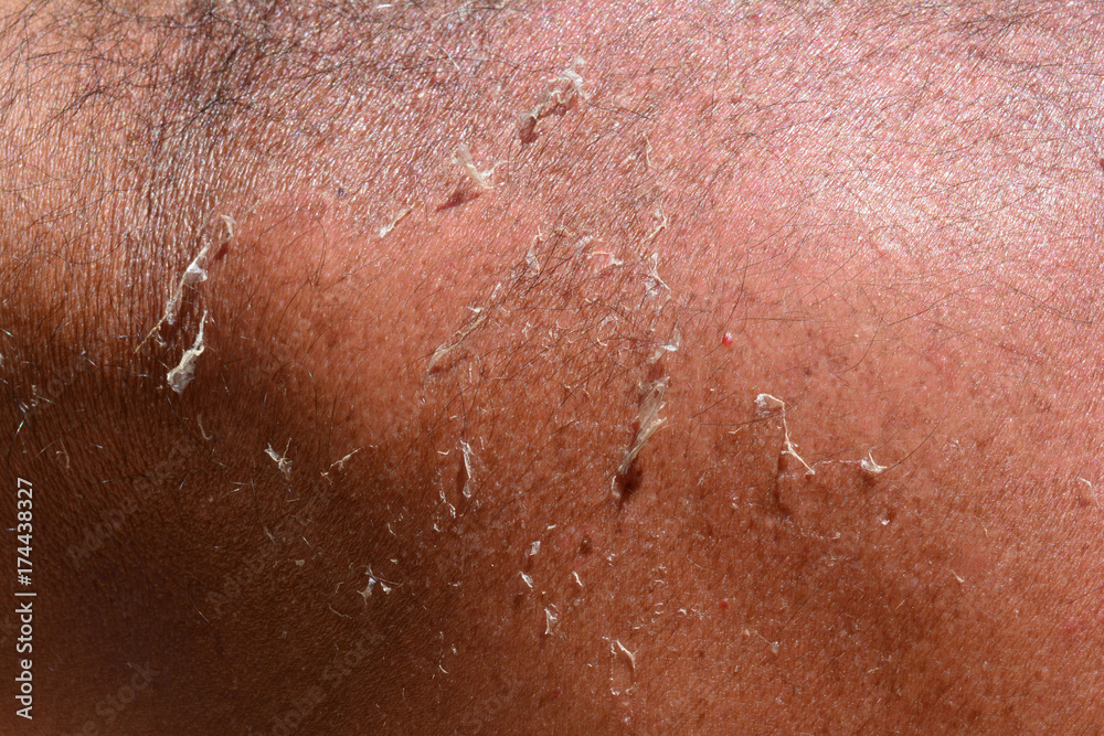 Fototapeta premium Tanned human skin with sunburns, close up