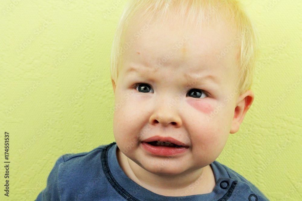 Baby with a big mosquito bite. Allergy to insect bites. A close-up of a mosquito bite under the eye. Sadness on the face of the child. Special photo processing, highlights an unpleasant symptom Baby with a big mosquito bite. Allergy to insect bites. A close-up of a mosquito bite under the eye. Sadness on the face of the child. Special photo processing, highlights an unpleasant symptom