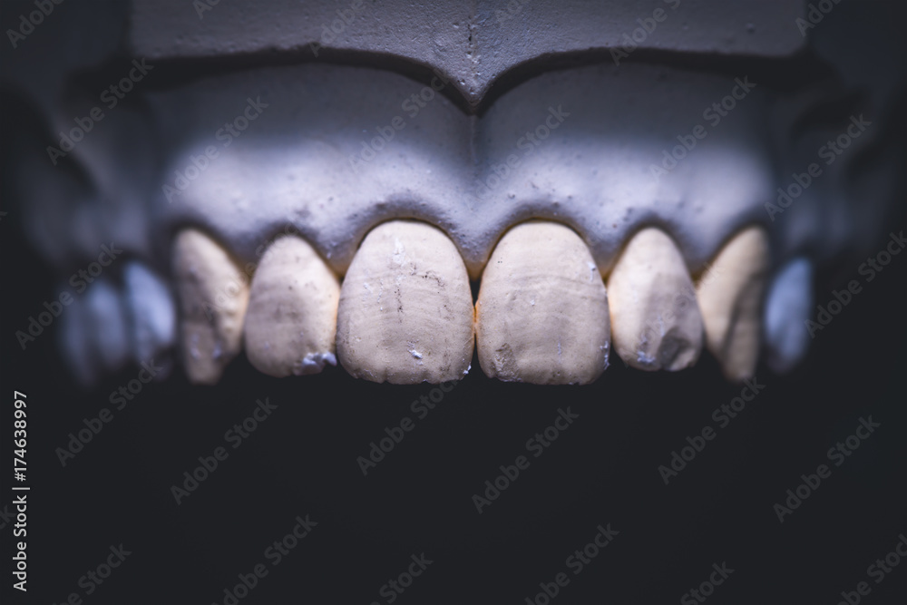 Obraz premium Dental prosthesis, artificial tooth. Photo of artificial teeth made in the dental laboratory.