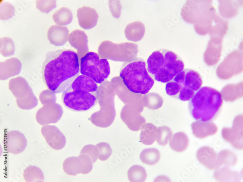 Φωτογραφία Blood picture of acute myeloid leukemia (AML), analyze by microscope
