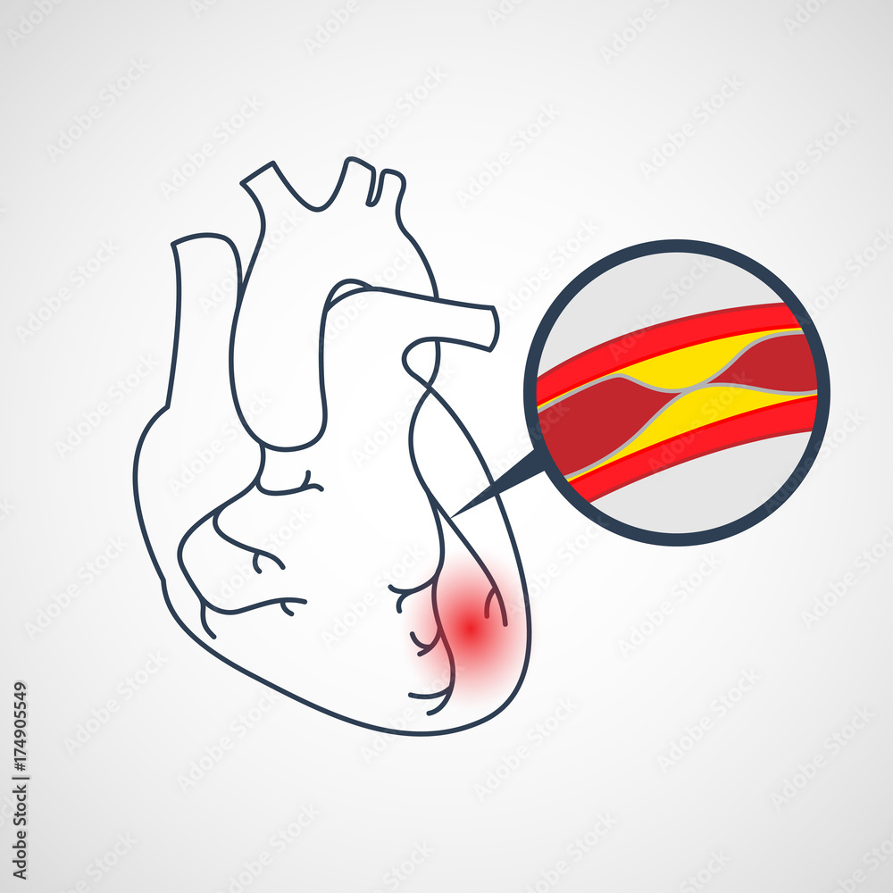 Obraz premium Coronary Artery Disease vector icon illustration