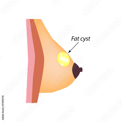 Fatty cyst breasts. Fat cyst. World Breast Cancer Day. Tumor of the mammary gland. Vector illustration on isolated background