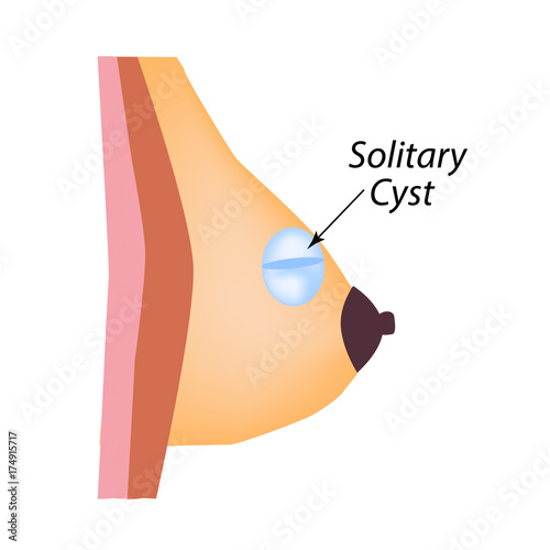 A solid cyst in the mammary gland. World Breast Cancer Day. Solitary cyst. Vector illustration on isolated background