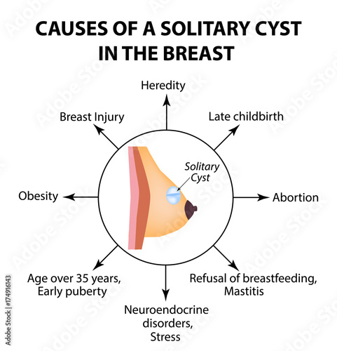 Causes of a solitary cyst in the breast. World Breast Cancer Day. A solid cyst. Vector illustration on isolated background