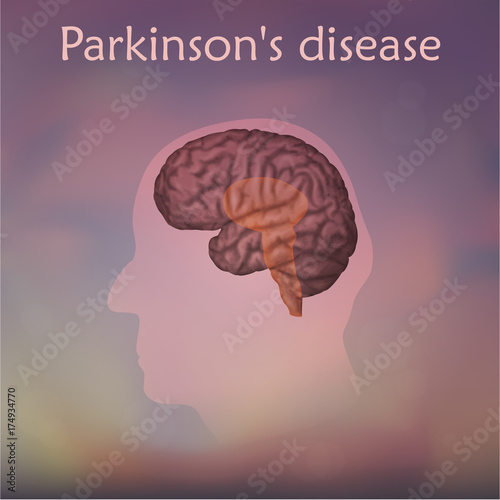 Parkinson's disease poster, banner. Vector medical illustration. Blurred background, pink silhouette of old man head, anatomy image of damaged human brain.