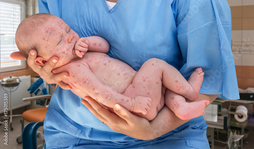 Newborn baby with chickenpox, measles or rubella