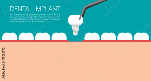 Dental implant flat vector