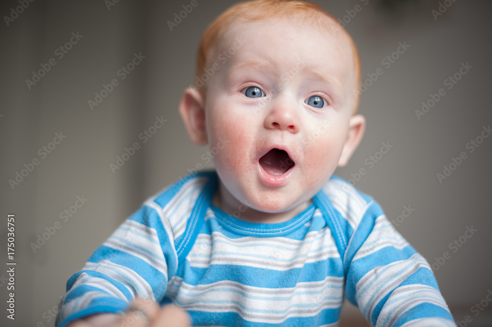 Redheaded baby boy with atopic dermatitis Redheaded baby boy with atopic dermatitis
