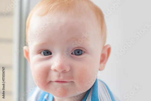 Redheaded baby boy with atopic dermatitis