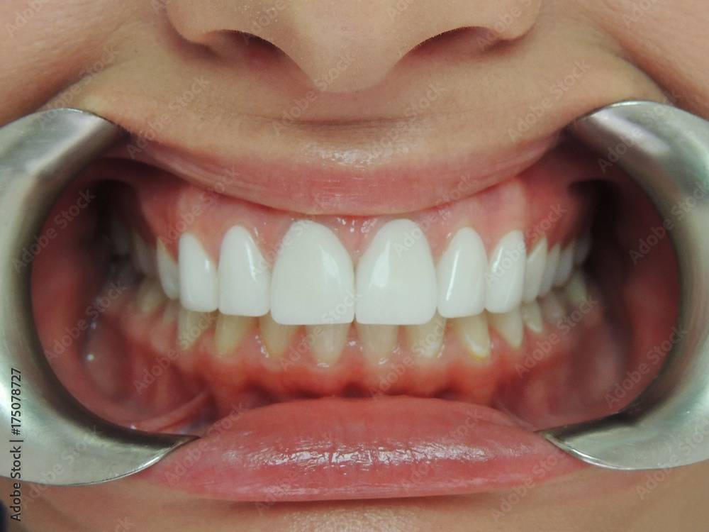 Fototapeta premium Close up of a patient's mouth at a dental clinic