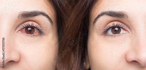 Fototapeta Naklejka Na Ścianę i Meble -  Woman with red eye before and after use of eyewash
