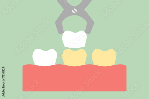dental veneers - tooth whitening