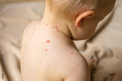 Baby with chicken pox photo