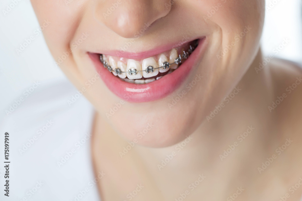 Obraz premium Woman in braces 