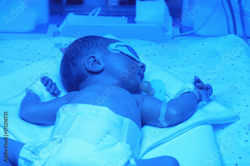 Newborn baby under blue UV light for phototheraphy on infant warmer in neonatal intensive care unit. Child baby having a treatment for jaundice under ultraviolet light in incubator. 