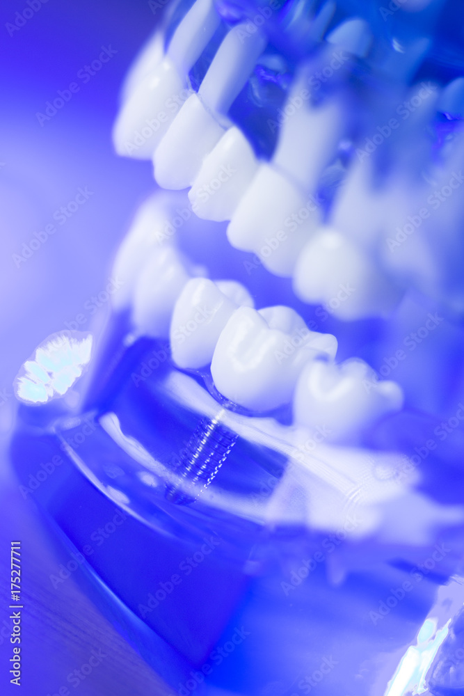 Dental alignment teeth model Dental alignment teeth model
