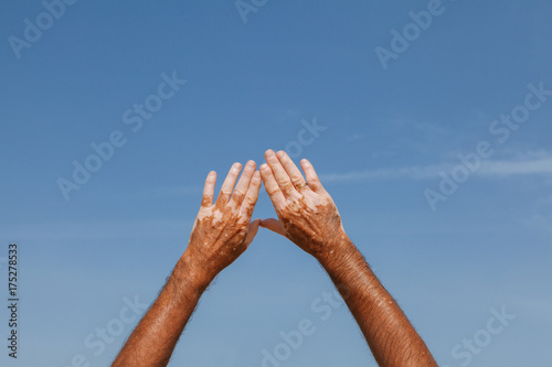 Hands with Vitiligo Skin Disease photo