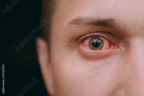Close up of one annoyed red blood eye of a man affected by conjunctivitis photo