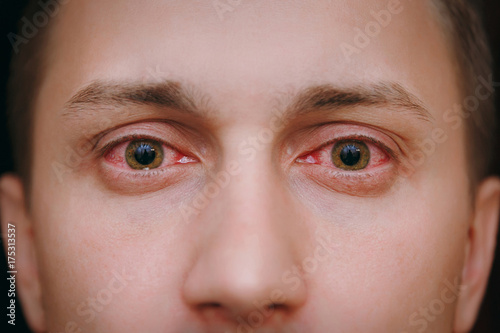 Close up of two annoyed red blood eyes of a man affected by conjunctivitis