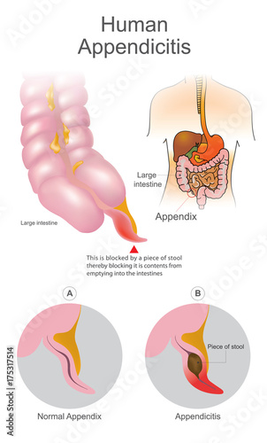 Human Appendicitis. A blocked by a piece of stool thereby blocking it is contents from emptying into intestines. Large Intestine system. Illustration human body parts.