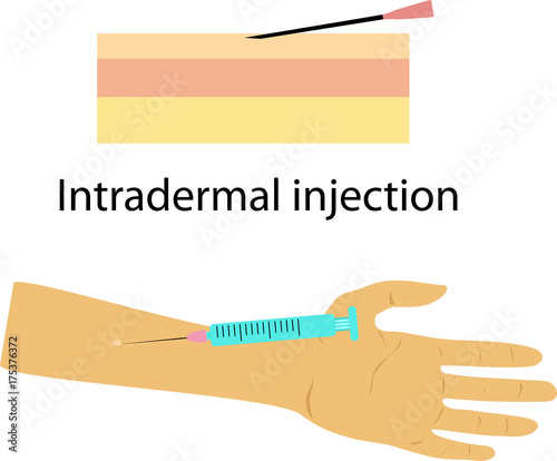 injections in the forearm