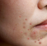 Close up of side face Problems with acne on the female skin