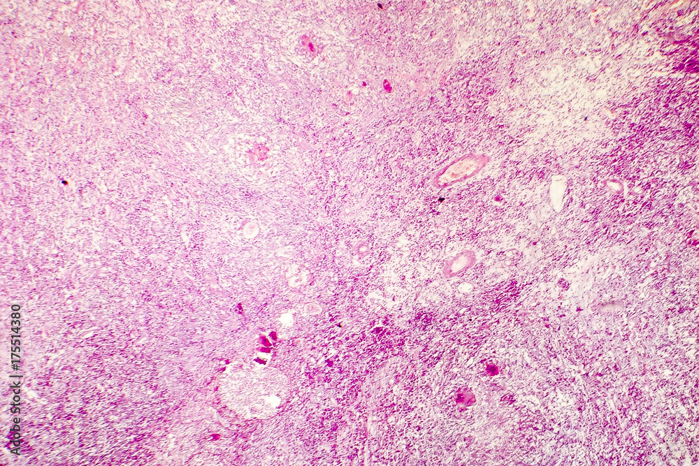 Fotografia do Stock Liquefactive necrosis of the human brain, light photomicrograph showing