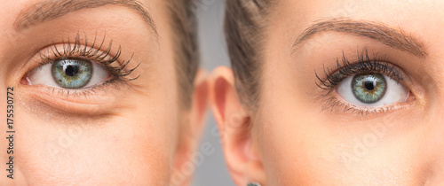 Woman eye bags before and after cosmetic treatment photo