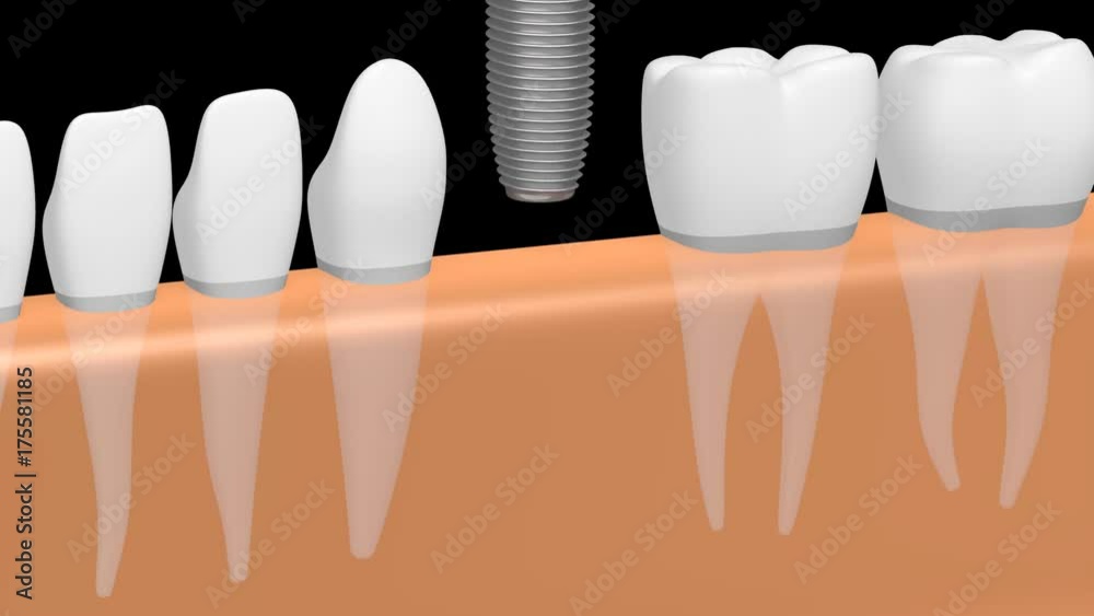 3D dental implant/ tooth implant animation - on black background. Stock