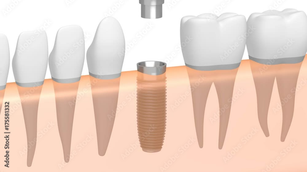 3D dental implant/ tooth implant animation - on white background.
3D dental implant/ tooth implant animation - on white background.
