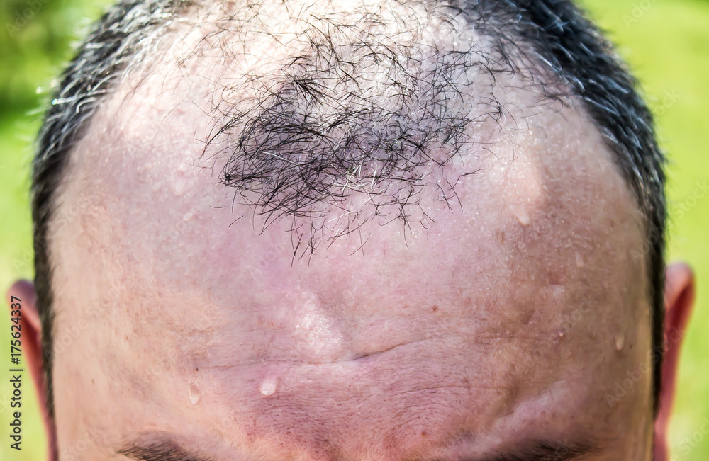 Obraz premium Balding man