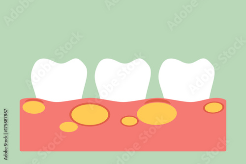 unhealthy teeth because gingivitis with abscess in gum and dental plaque or tartar