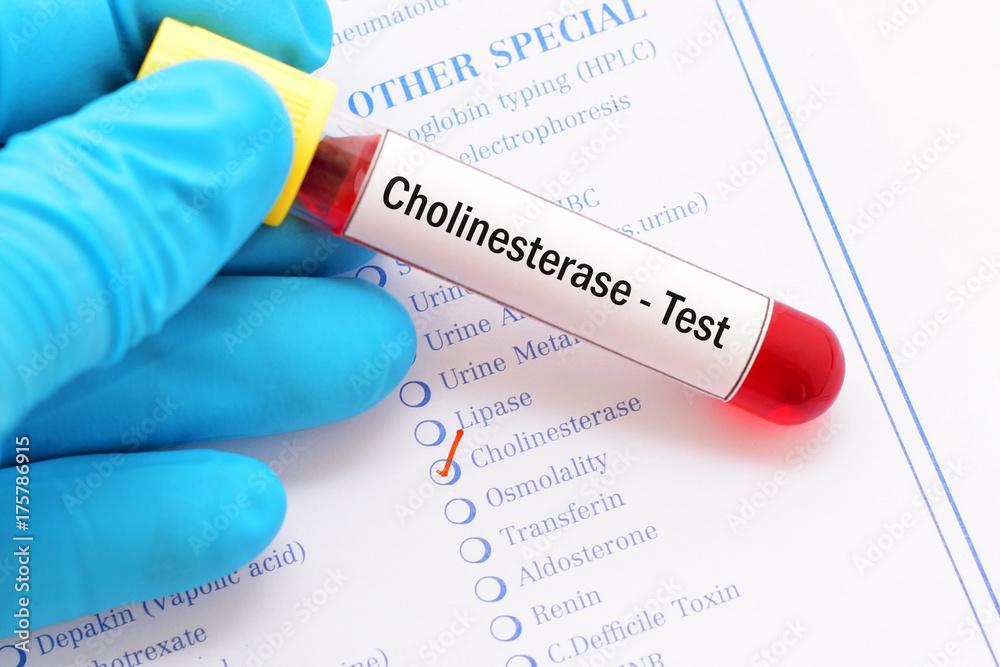 Obraz premium Blood sample for cholinesterase test