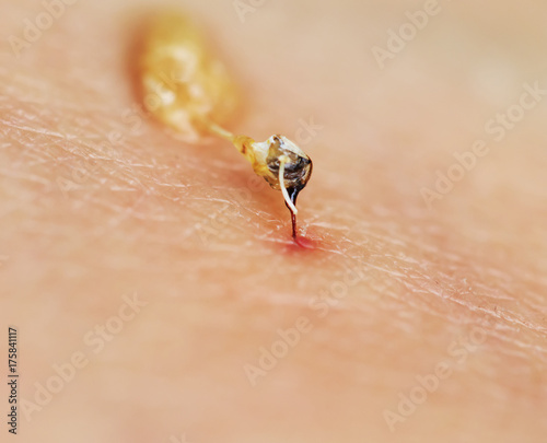 sharp bee sting painfully pierced the skin and injected the poison