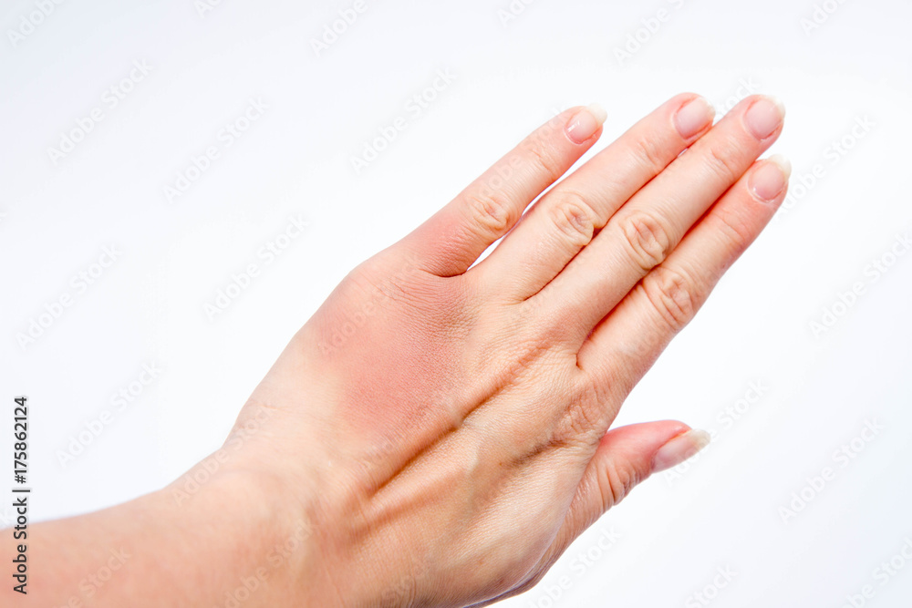 Woman's hand with a bruise Woman's hand with a bruise