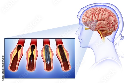 Illustration of brain stent angioplasty to treat and prevent a stroke