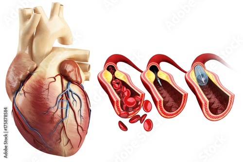 Coronary angioplasty stent insertion, illustration photo
