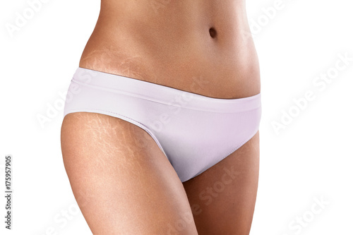 Foto female hips with a stretch marks