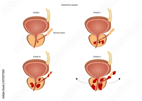 Various stages of a prostate cancer.