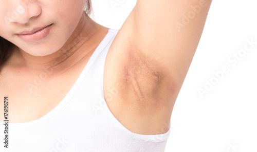 Women problem black armpit on white background for skin care and beauty concept photo