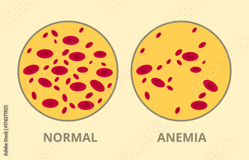 compare between normal blood cell vs anemia disease sick