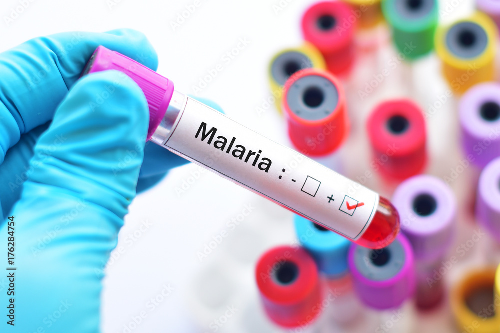 Obraz premium Blood sample with malaria parasite positive