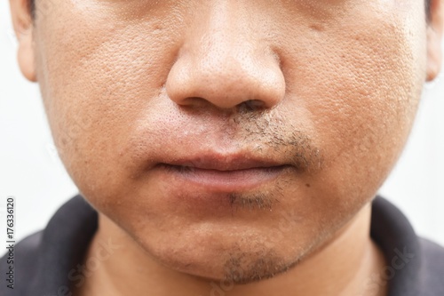 some mustache after withdrawal mustache on surface young asian man face skin do not take care for a long time