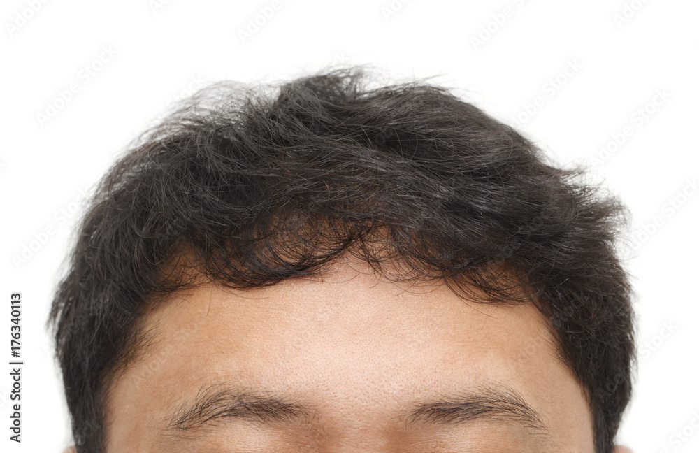 Male head with hair loss symptoms front side, close-up isolated on white background