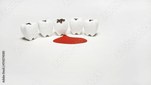 Фотография Decayed tooth model and Scurvy Teeth Bleeding for Dental Unhealthy