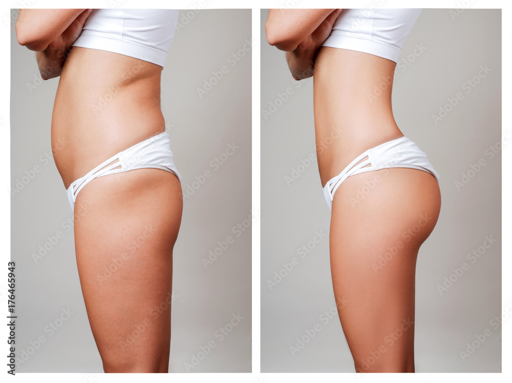 Female body before and after treatment. Plastic surgery. - obrazy, fototapety, plakaty 